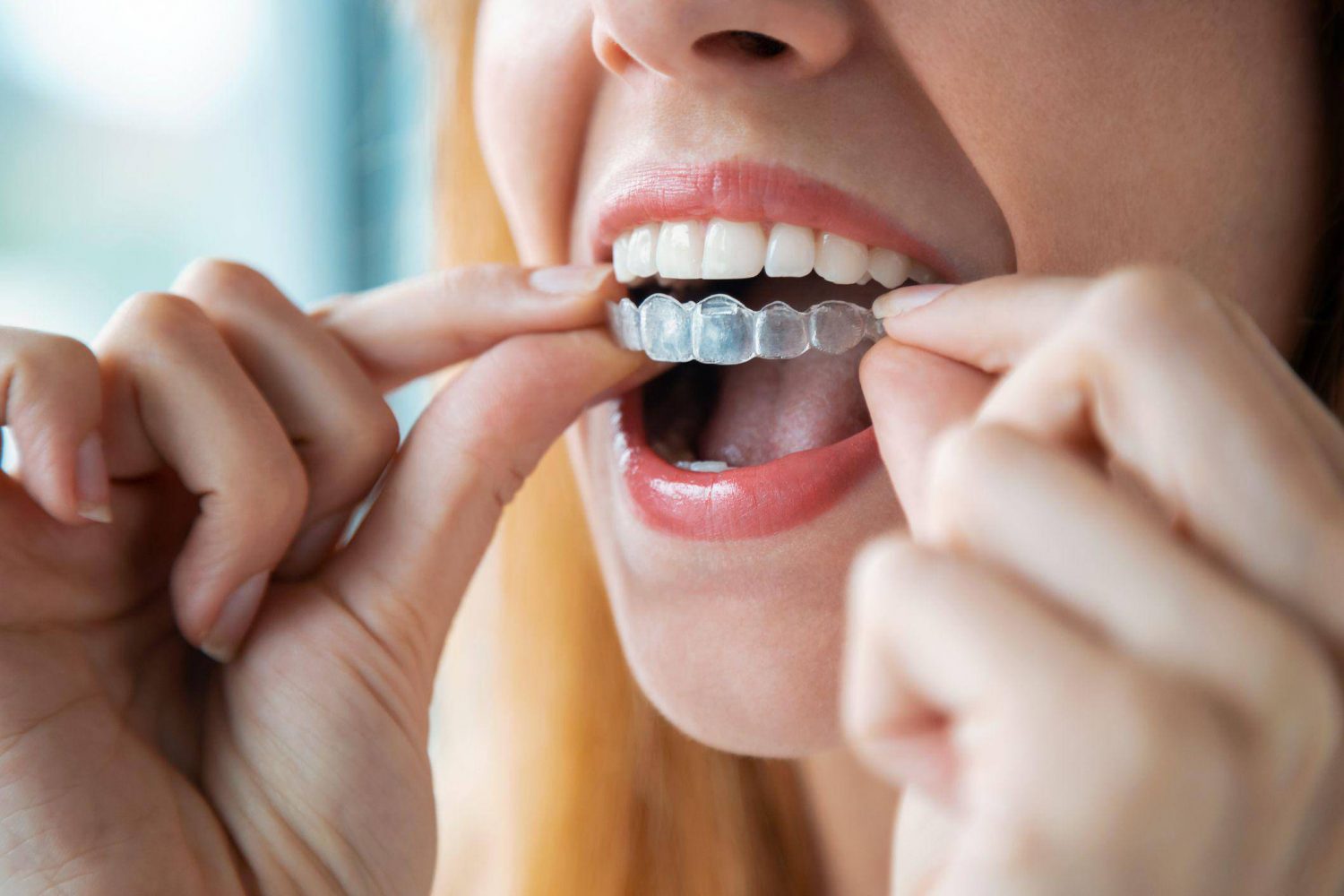 How Invisalign Aligners Facilitate Faster Adaptation Periods Compared to Fixed Orthodontic Appliances